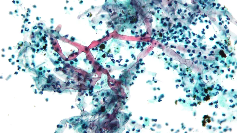 Micrograph of zygomycosis (also mucormycosis - more specific)