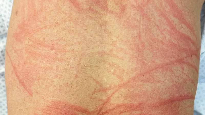 shiitake dermatitis allergic reaction